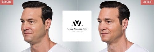 Kybella before and after, result 9