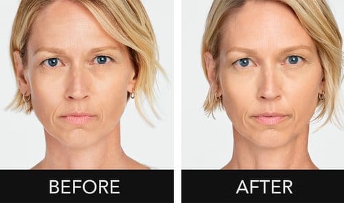 Radiesse before and after, result 4
