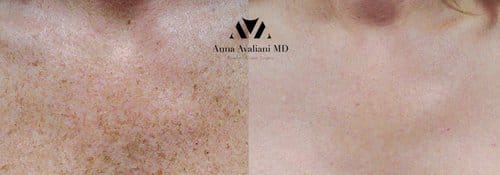 PicoSure / Laser Skin Rejuvenation before and after, result 64