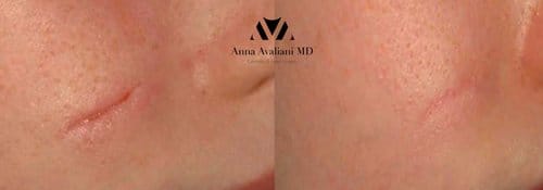 PicoSure / Laser Skin Rejuvenation before and after, result 65
