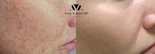 PicoSure / Laser Skin Rejuvenation before and after, result 66