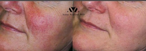 PicoSure / Laser Skin Rejuvenation before and after, result 67