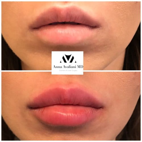 Lip Augmentation before and after, result 23