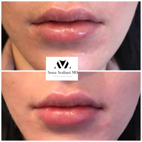 Lip Augmentation before and after, result 32
