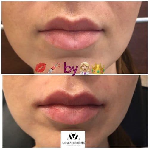 Lip Augmentation before and after, result 33