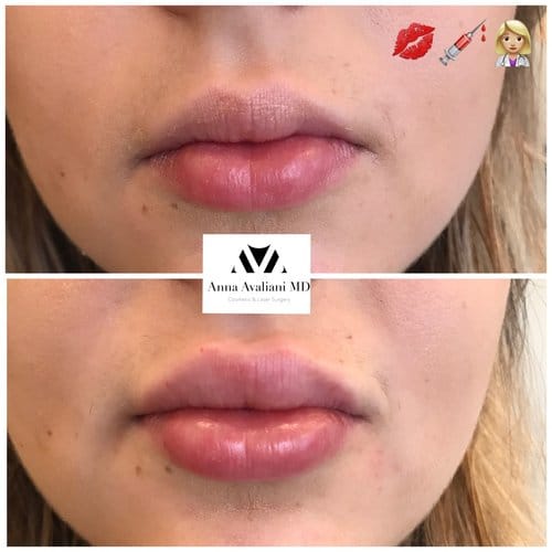 Lip Augmentation before and after, result 34