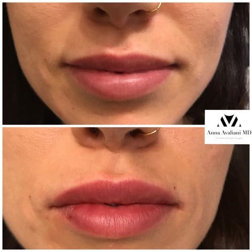 Lip Augmentation before and after, result 35