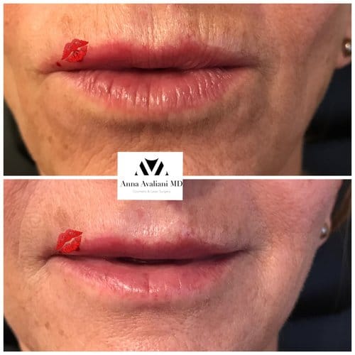 Lip Augmentation before and after, result 36