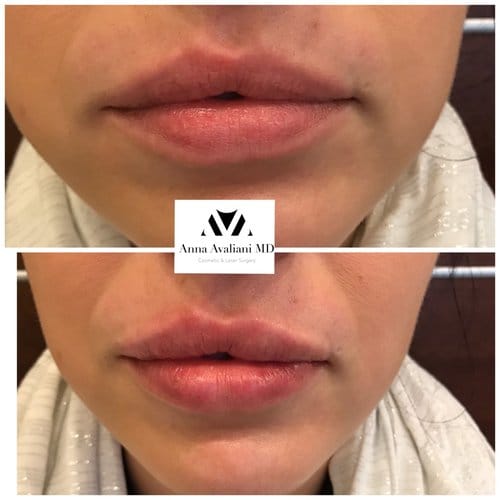 Lip Augmentation before and after, result 37