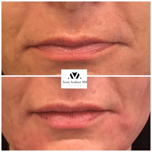 Lip Augmentation before and after, result 38