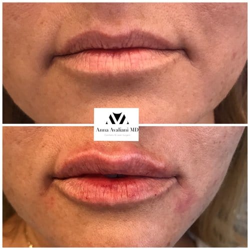 Lip Augmentation before and after, result 39