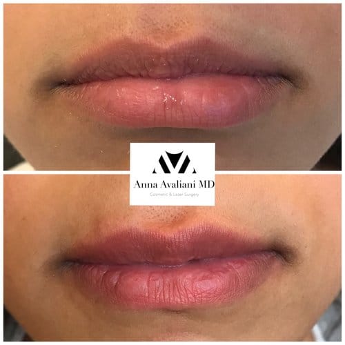 Lip Augmentation before and after, result 40