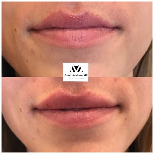 Lip Augmentation before and after, result 41