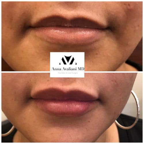 Lip Augmentation before and after, result 24