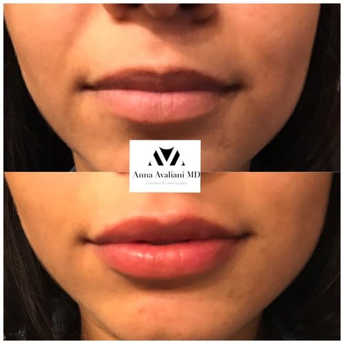 Lip Augmentation before and after, result 42