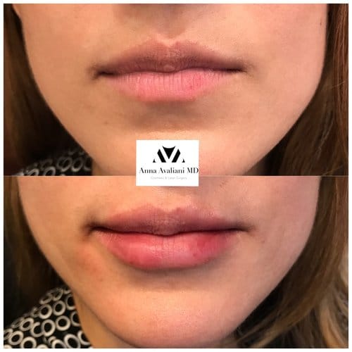Lip Augmentation before and after, result 43