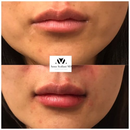 Lip Augmentation before and after, result 44