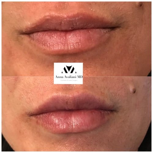 Lip Augmentation before and after, result 22