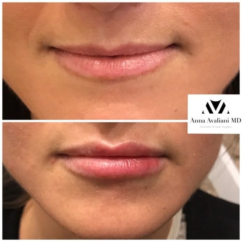 Lip Augmentation before and after, result 25