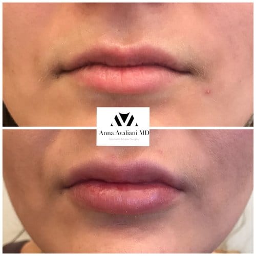 Lip Augmentation before and after, result 26