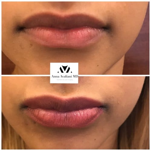 Lip Augmentation before and after, result 27