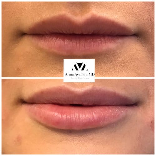 Lip Augmentation before and after, result 28