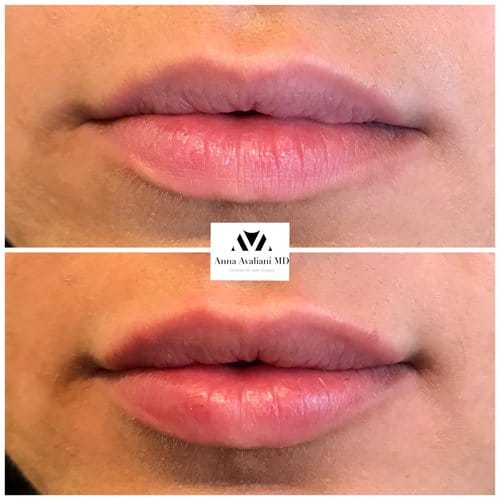 Lip Augmentation before and after, result 29