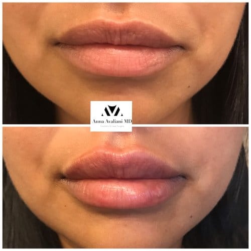 Lip Augmentation before and after, result 30