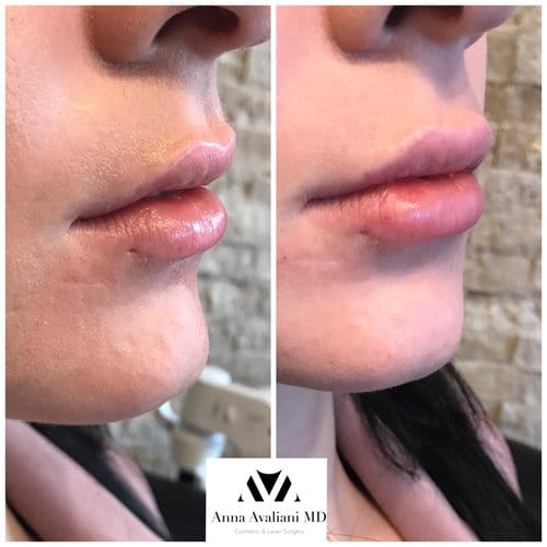 Lip Augmentation before and after, result 31