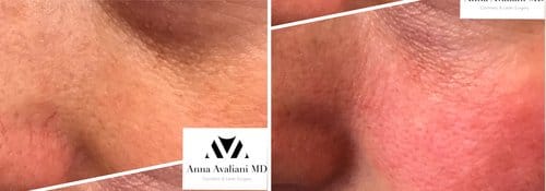 PicoSure / Laser Skin Rejuvenation before and after, result 49