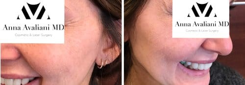 PicoSure / Laser Skin Rejuvenation before and after, result 50