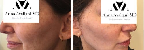 PicoSure / Laser Skin Rejuvenation before and after, result 51
