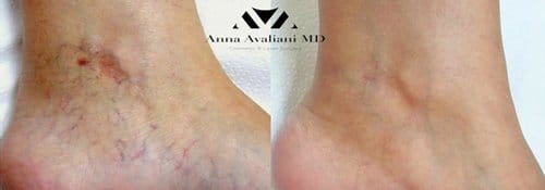 PicoSure / Laser Skin Rejuvenation before and after, result 68