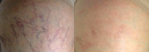 PicoSure / Laser Skin Rejuvenation before and after, result 69