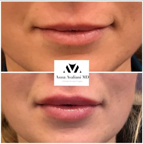 Lip Augmentation before and after, result 51