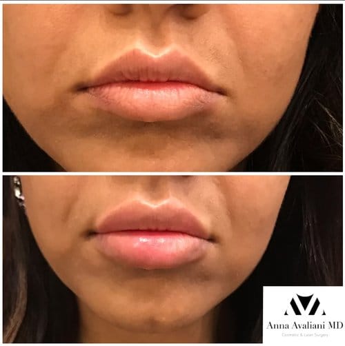 Lip Augmentation before and after, result 52