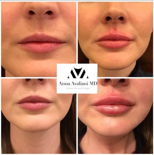 Lip Augmentation before and after, result 53
