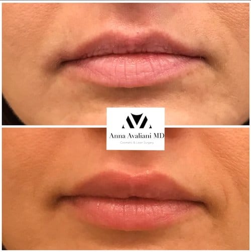 Lip Augmentation before and after, result 54