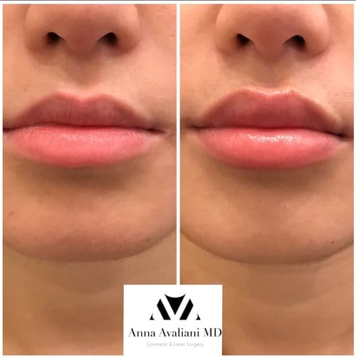 Lip Augmentation before and after, result 55