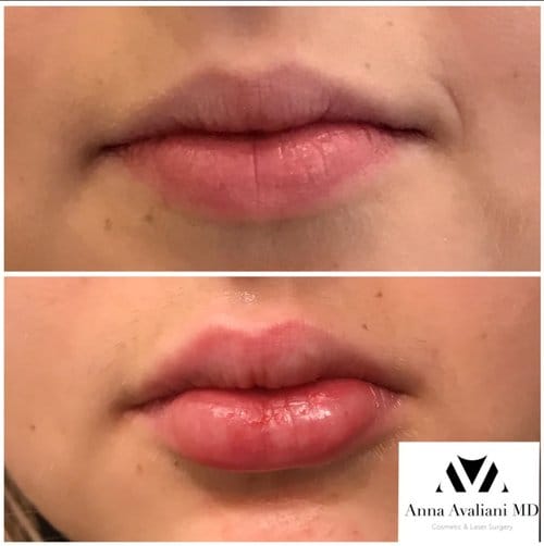 Lip Augmentation before and after, result 56