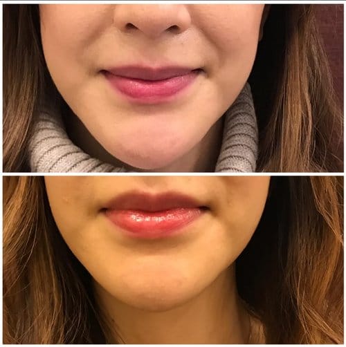 Lip Augmentation before and after, result 57