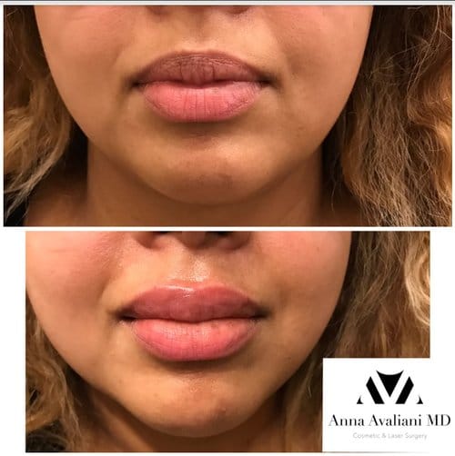 Lip Augmentation before and after, result 58