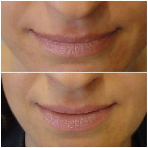 Lip Augmentation before and after, result 59