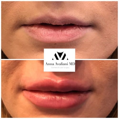 Lip Augmentation before and after, result 60