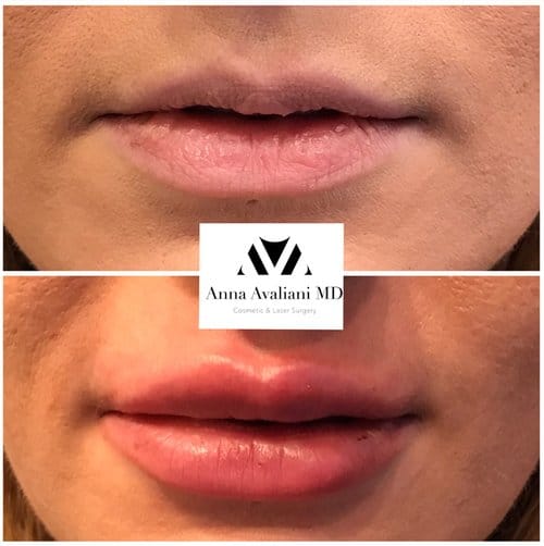 Lip Augmentation before and after, result 50