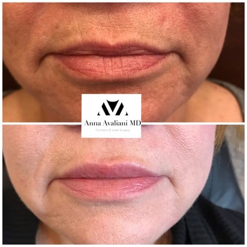 Lip Augmentation before and after, result 69