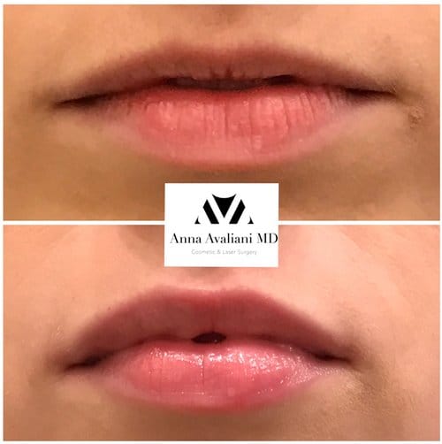 Lip Augmentation before and after, result 48