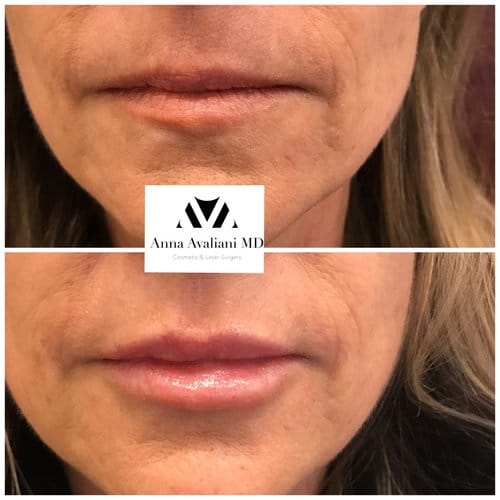 Lip Augmentation before and after, result 63