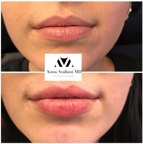 Lip Augmentation before and after, result 47