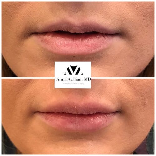 Lip Augmentation before and after, result 64